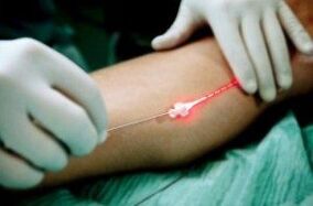 Θεραπεία με λέιζερ των κιρσών των φλεβών στα πόδια