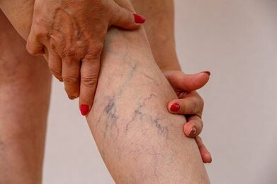 Κιρσοί των κάτω άκρων