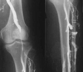 Επιλογές διάγνωσης για κιρσούς των άκρων